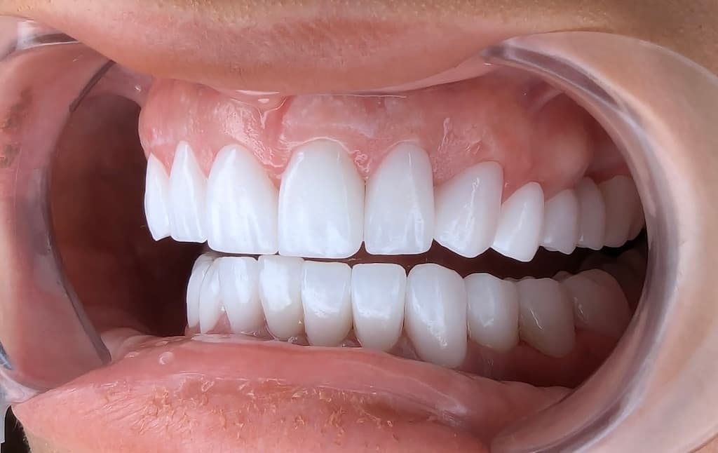 Hollywood Smile