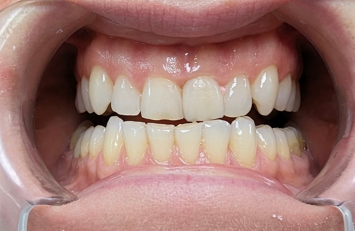 Grand Dental klinika - pre i posle