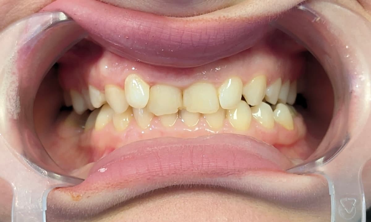 Grand Dental klinika - pre i posle