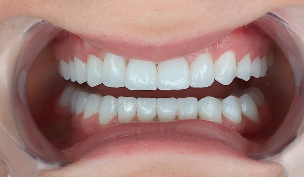 Grand Dental klinika - pre i posle