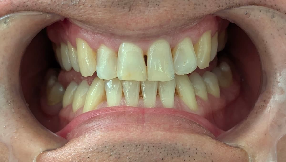 Grand Dental klinika - pre i posle