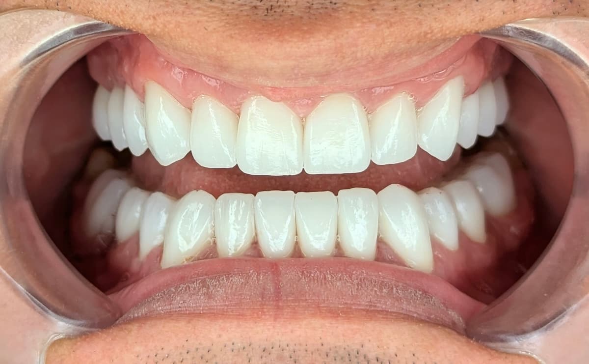 Grand Dental klinika - pre i posle