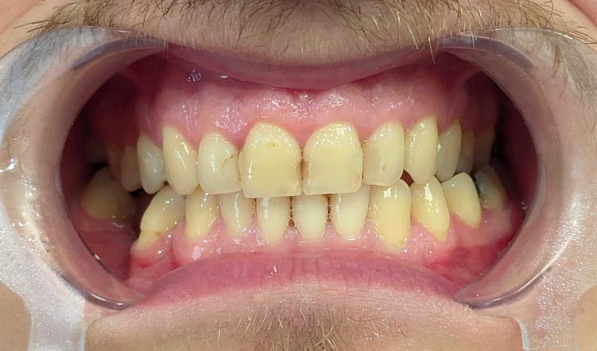 Grand Dental klinika - pre i posle