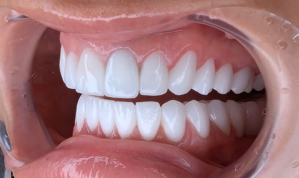 Hollywood Smile