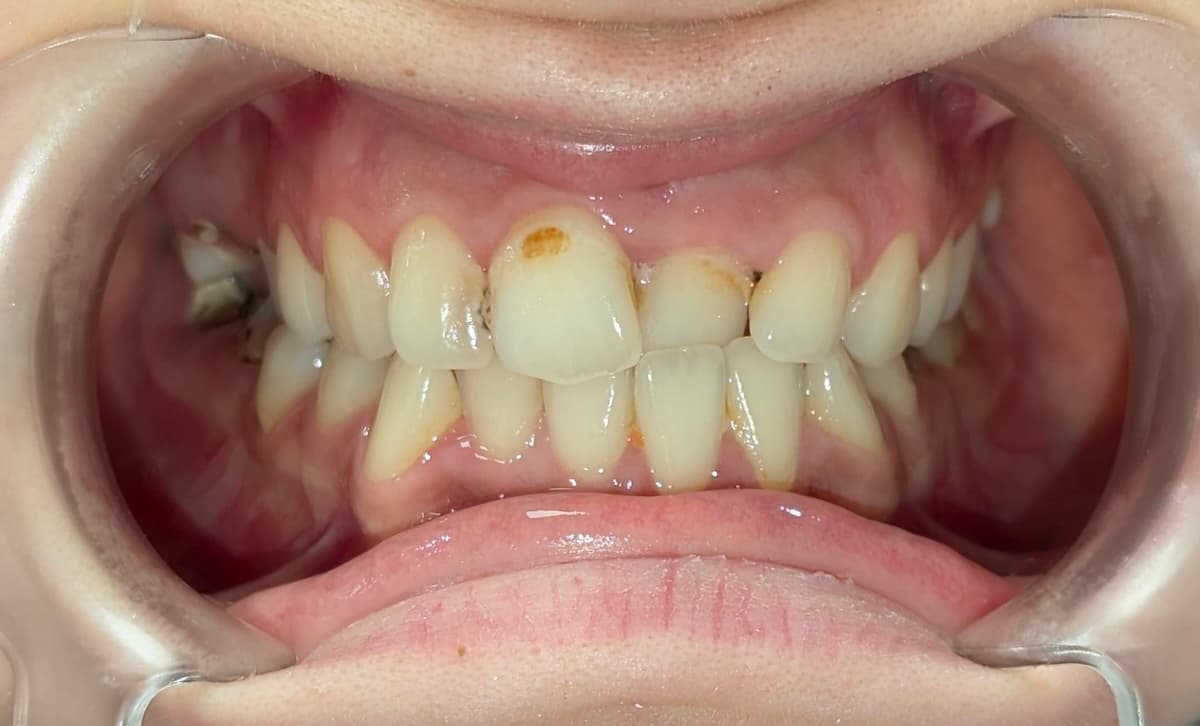 Grand Dental klinika - pre i posle