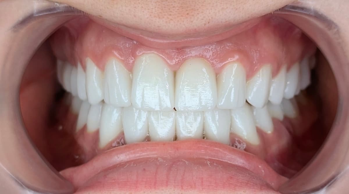 Grand Dental klinika - pre i posle