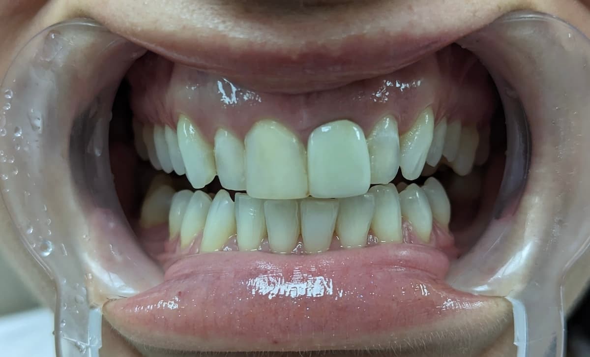 Grand Dental klinika - pre i posle