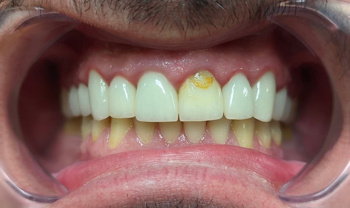 Grand Dental klinika - pre i posle