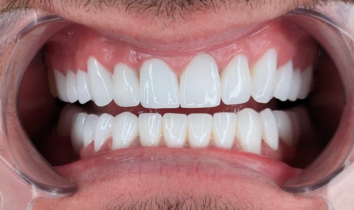 Grand Dental klinika - pre i posle