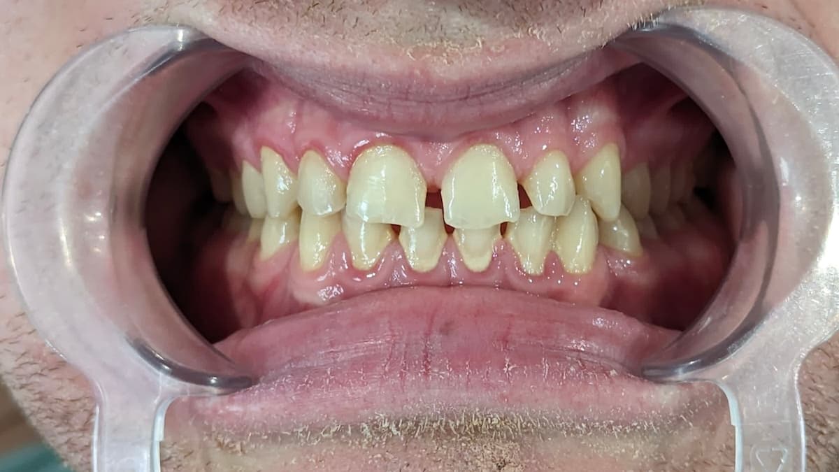 Grand Dental klinika - pre i posle