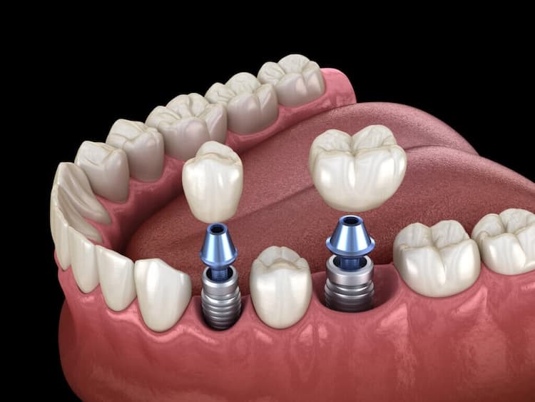 Hirurgija i implantologija u Grand Dentalu u Grand Dentalu