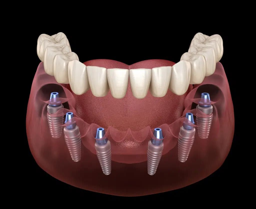 Hirurgija i implantologija u Grand Dentalu u Grand Dentalu