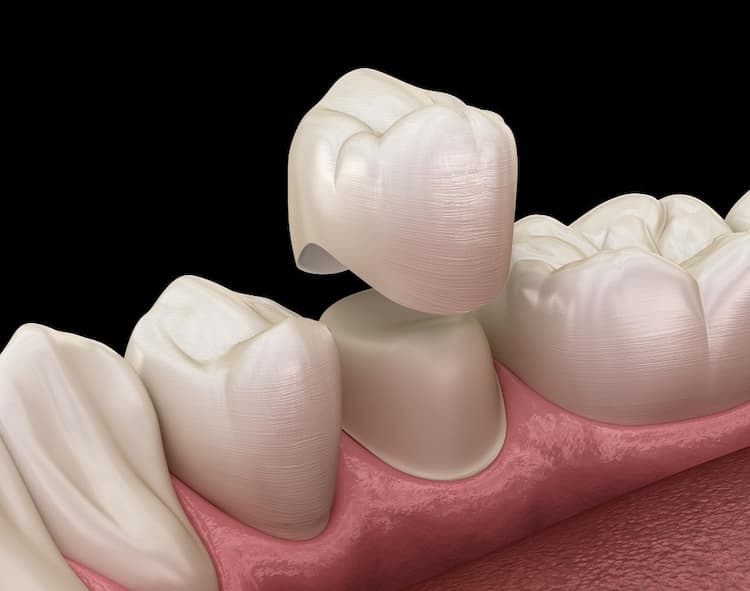 Protetika u Grand Dentalu u Grand Dentalu