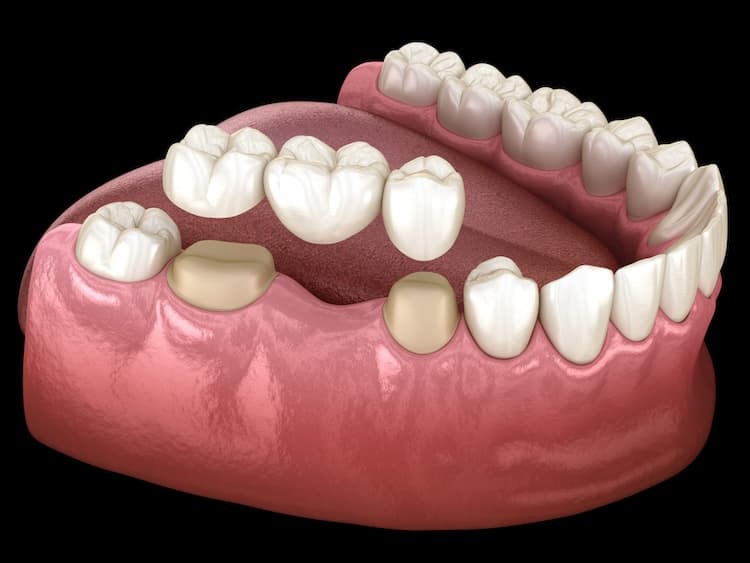 Protetika u Grand Dentalu u Grand Dentalu